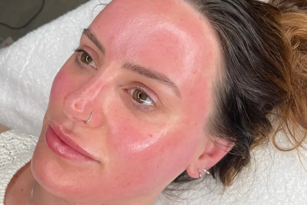 dermapen microneedling