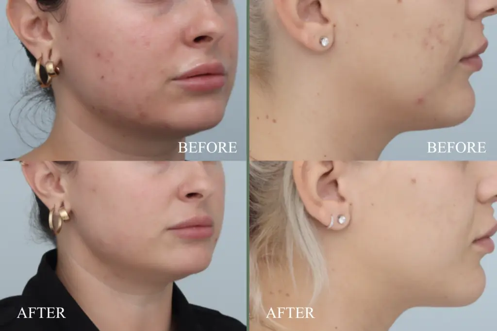 before after microneedling