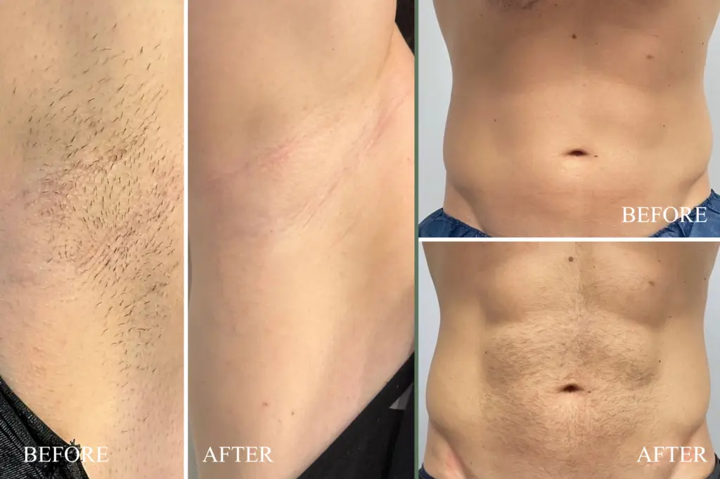 laser hair removal Cynosure Elite+