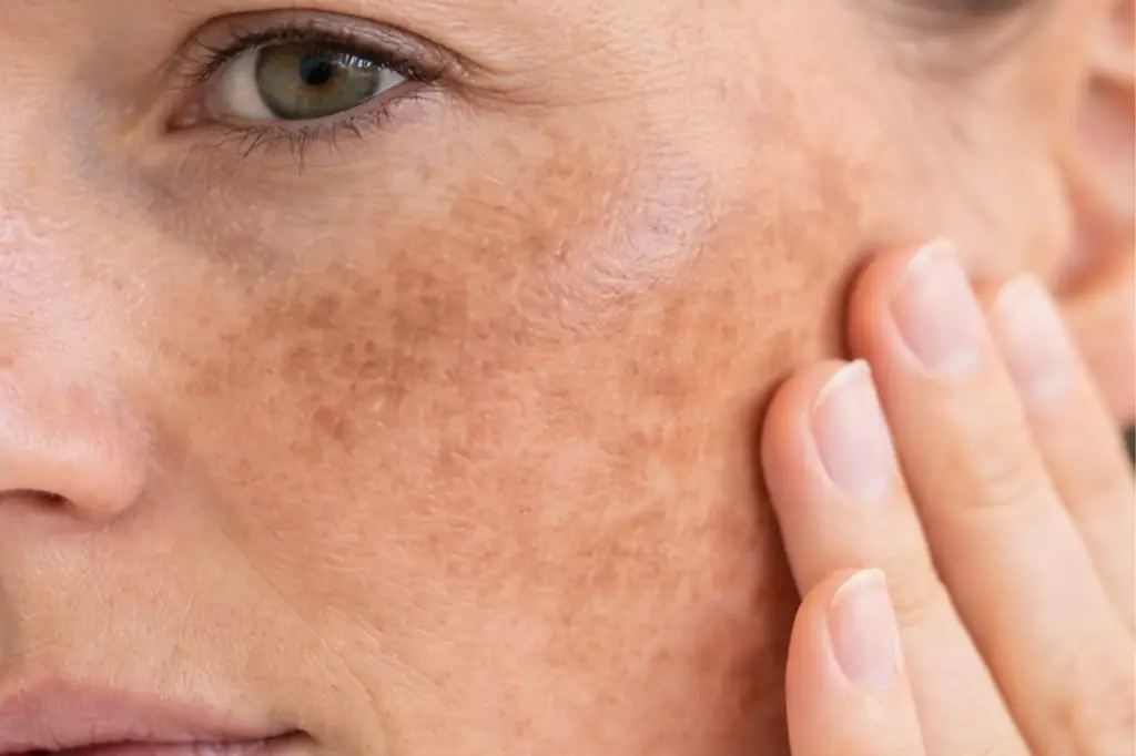 melasma