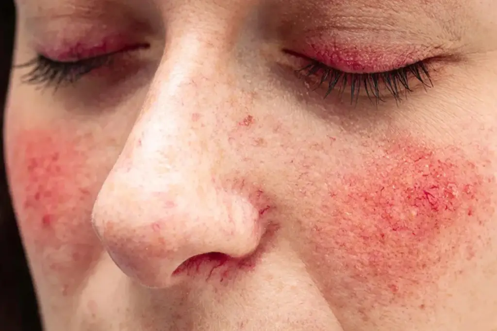rosacea