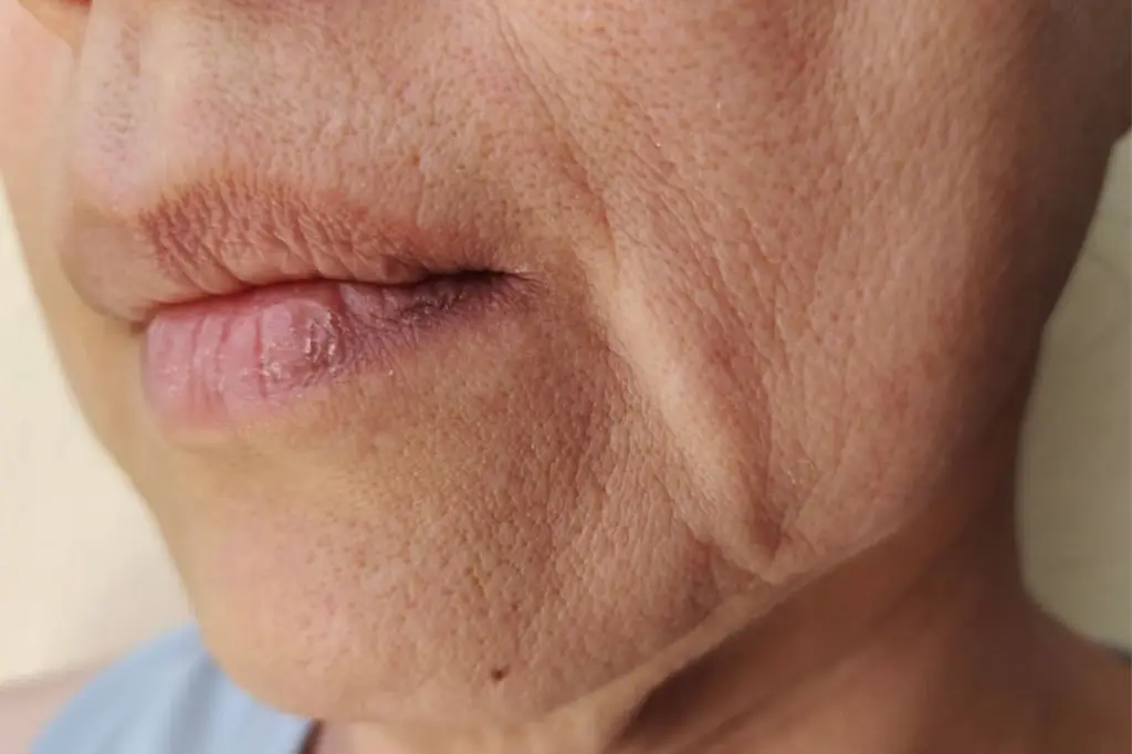 Volume Loss & Facial Contouring