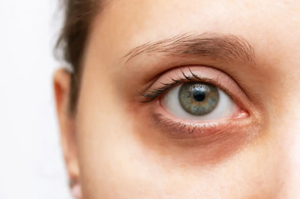 dark circles