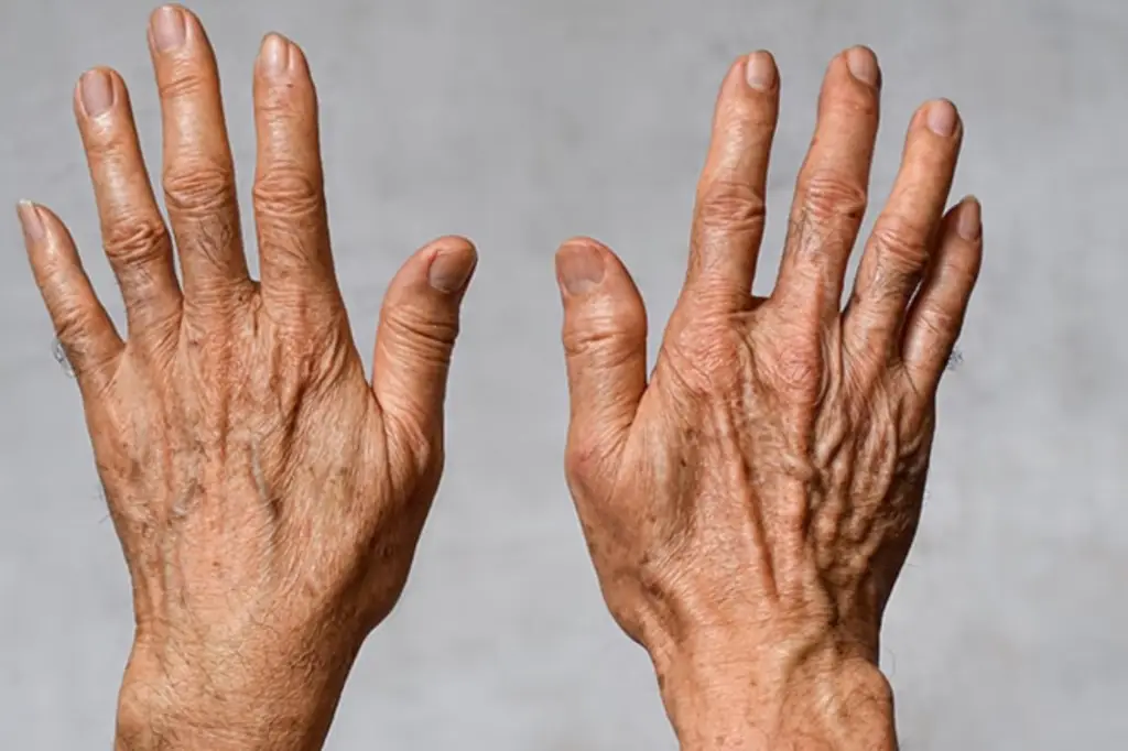 Hand Rejuvenation