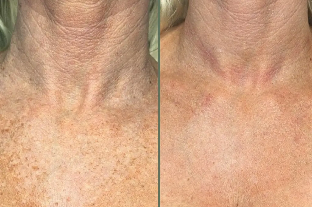 NECK REJUVENATION & "TECH-NECK" CORRECTION