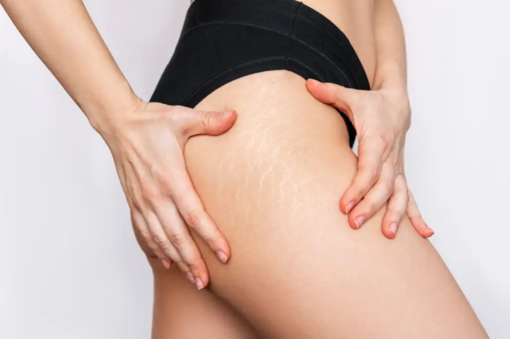 BEYOND THE CREAMS: A CLINICAL PATHWAY TO REBUILDING STRETCH MARKS