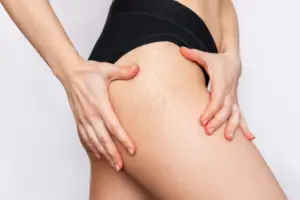 BEYOND THE CREAMS: A CLINICAL PATHWAY TO REBUILDING STRETCH MARKS