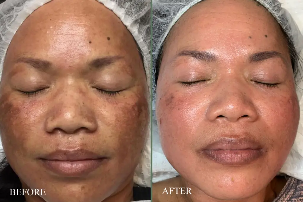 before after cosmelan