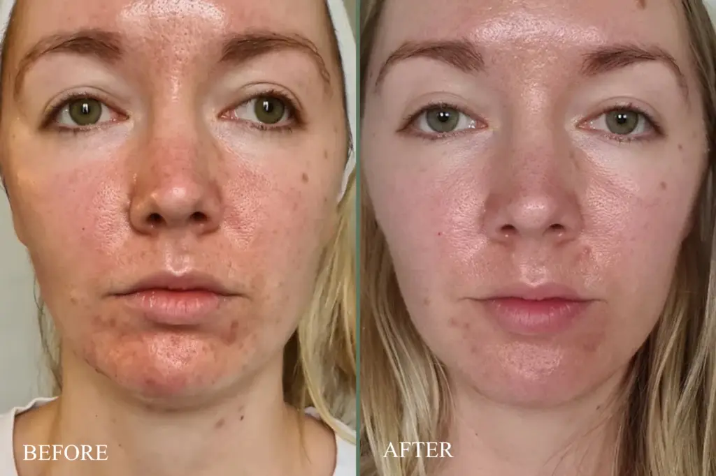 before after laser genesis