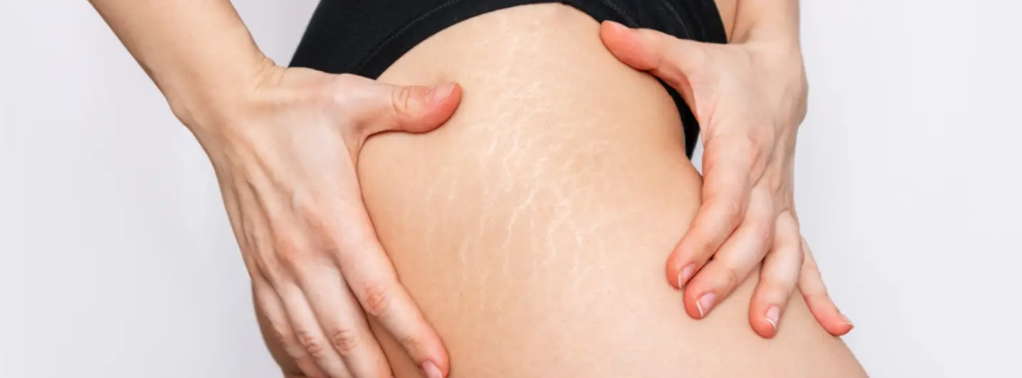BEYOND THE CREAMS: A CLINICAL PATHWAY TO REBUILDING STRETCH MARKS