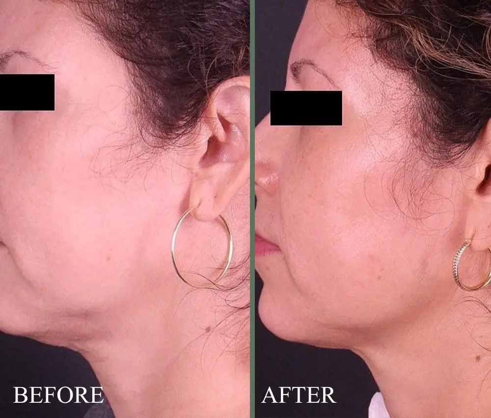 before after laser genesis