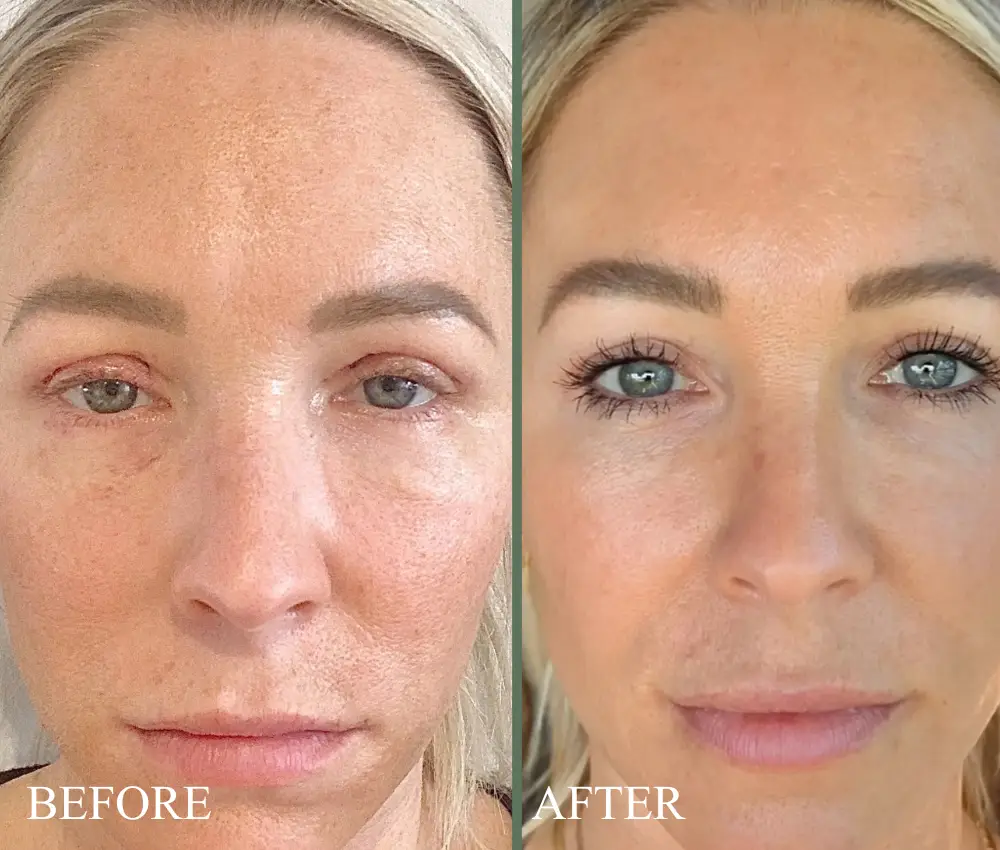 before after sylfirm
