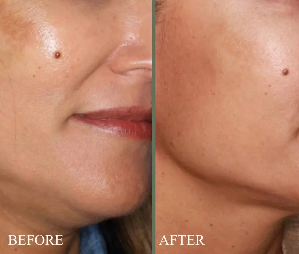 before after sylfirm x