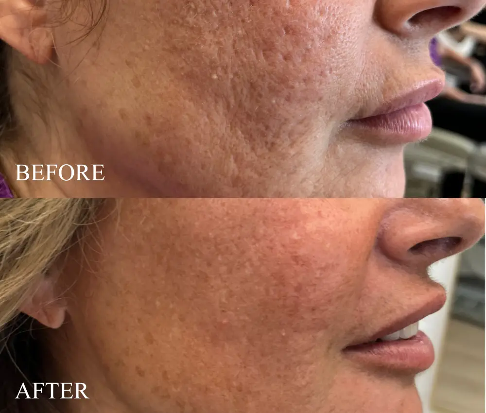 before after dermapen