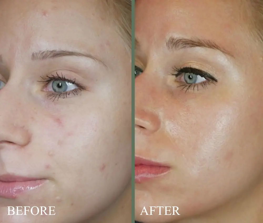 before after microneedling and laser genesis