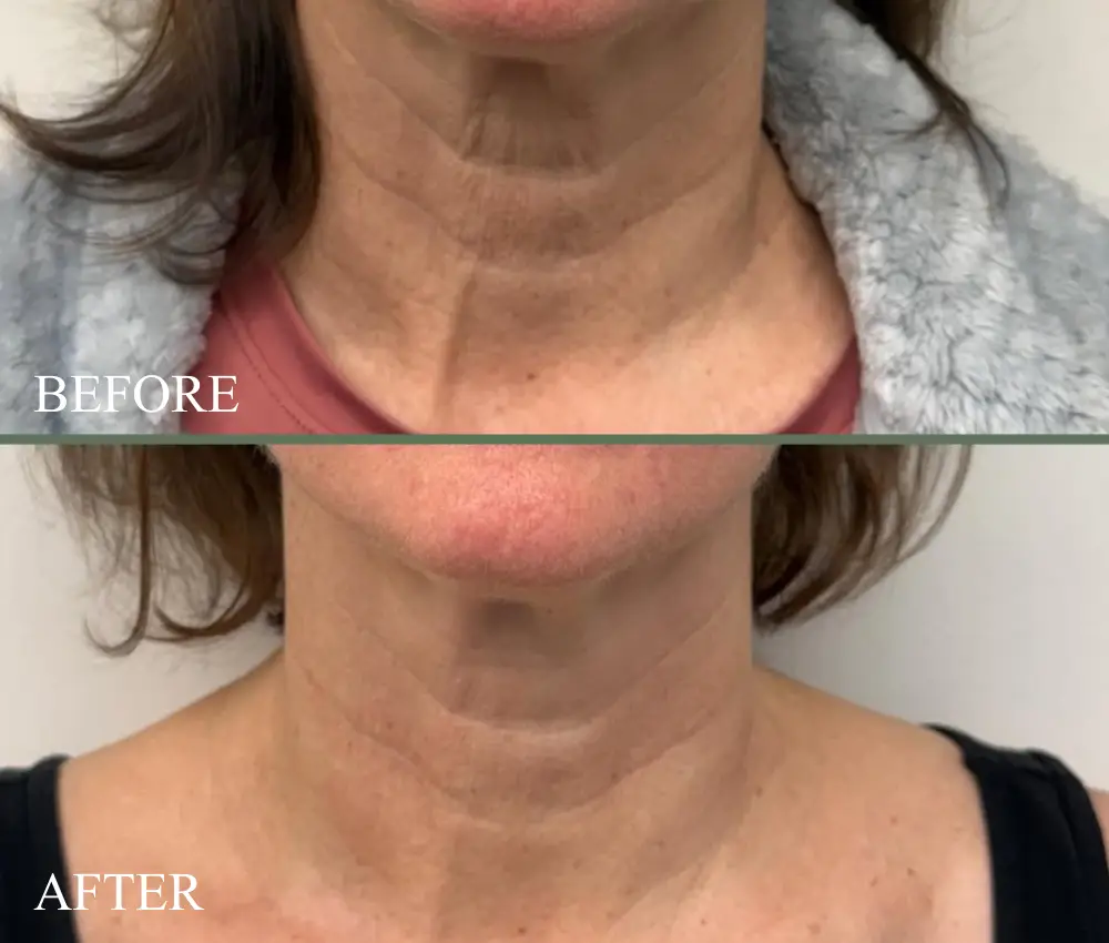 before after microneedling