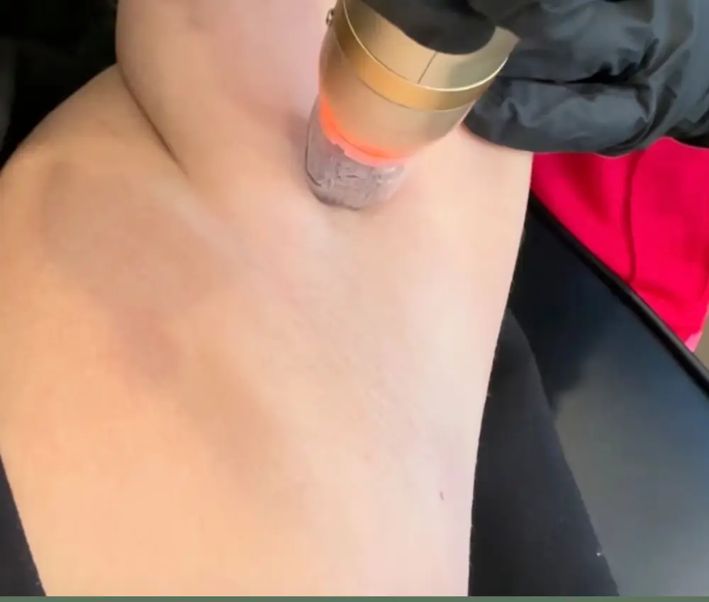 sylfirm Hyperhidrosis