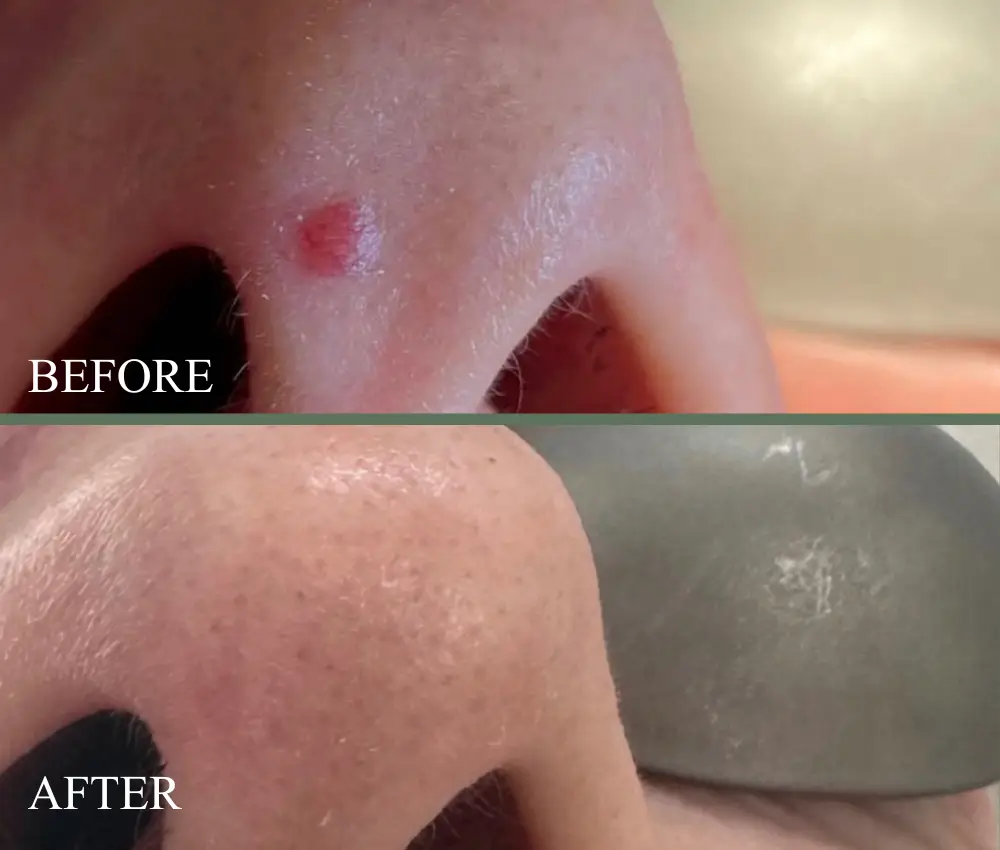 angioma before and after