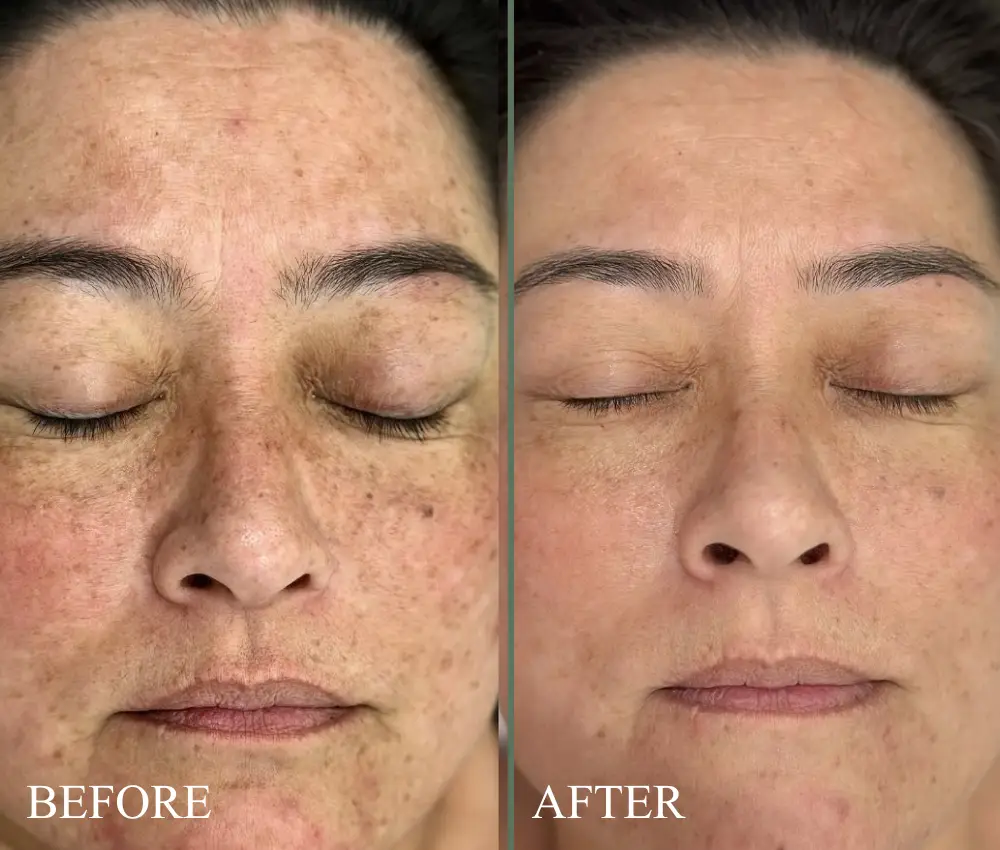 before after exosomes