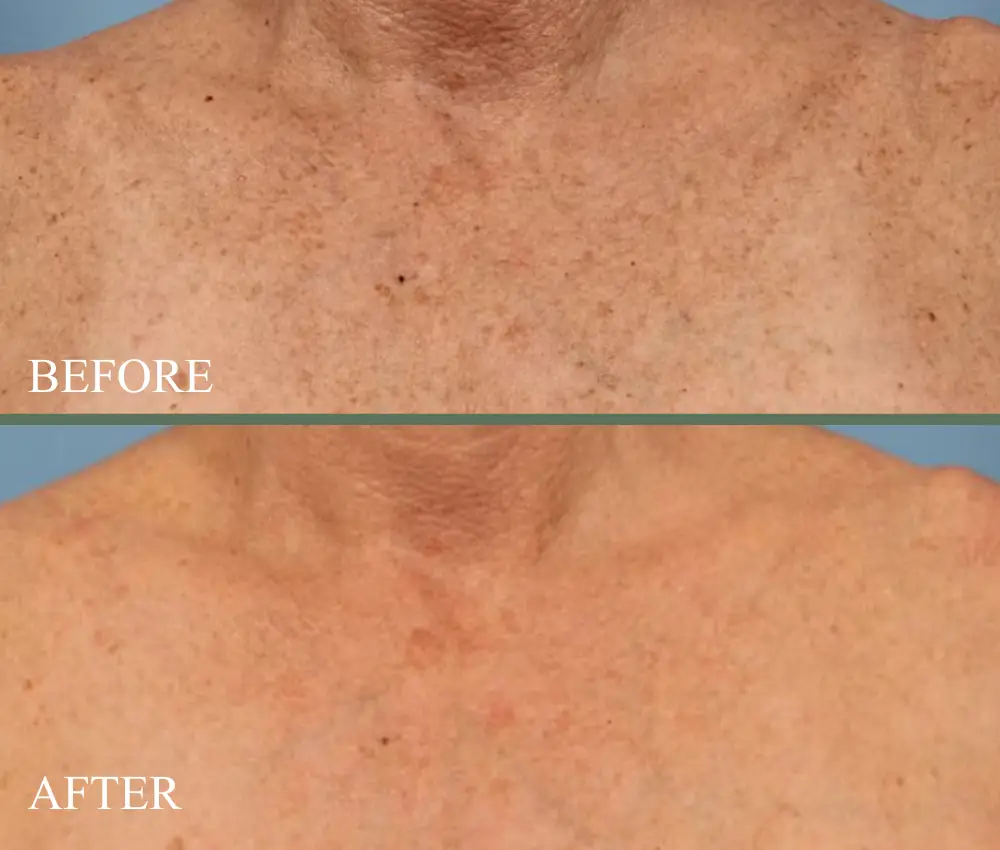before after candela