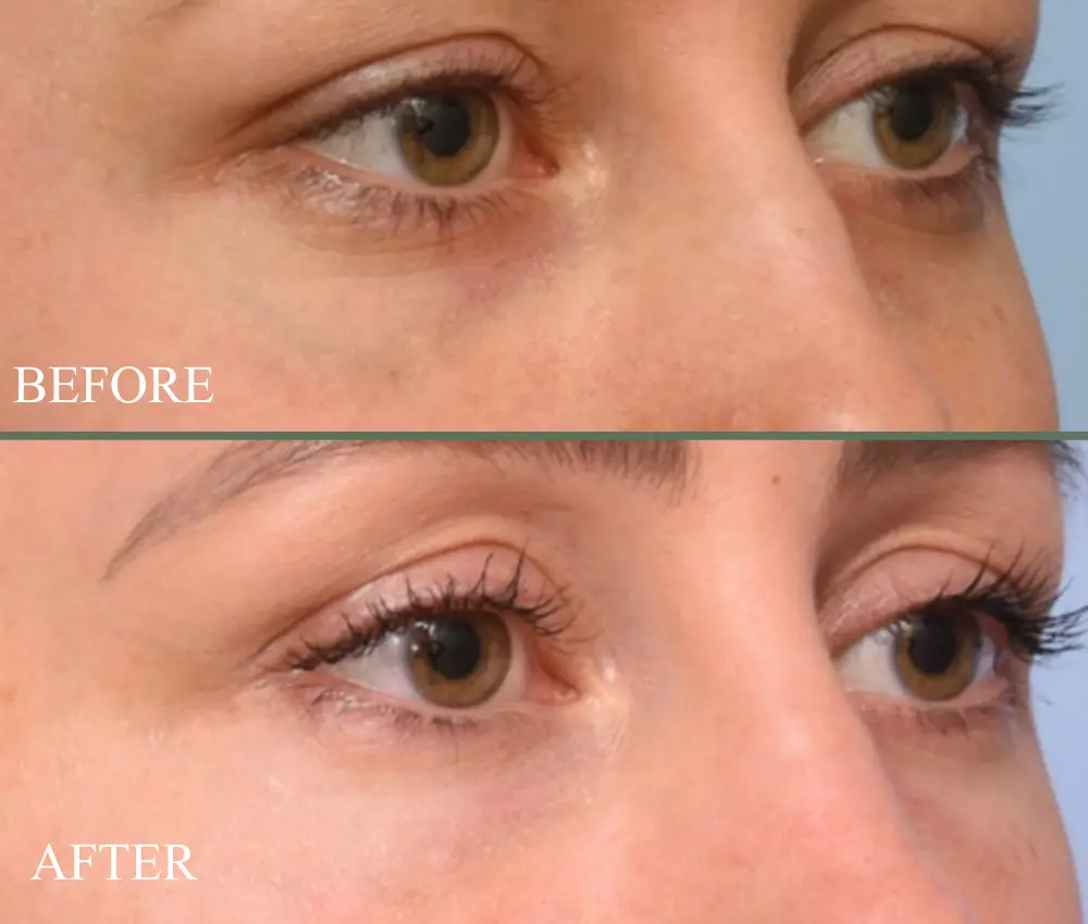before and after Candela Nd:YAG