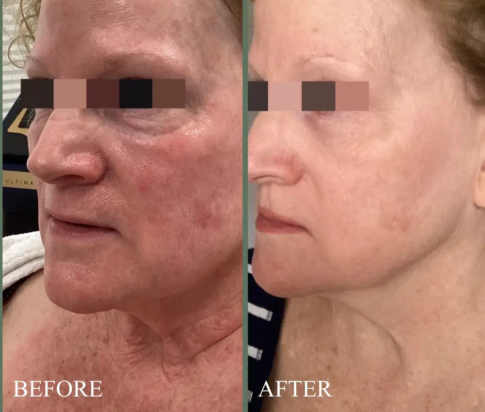before after rosacea