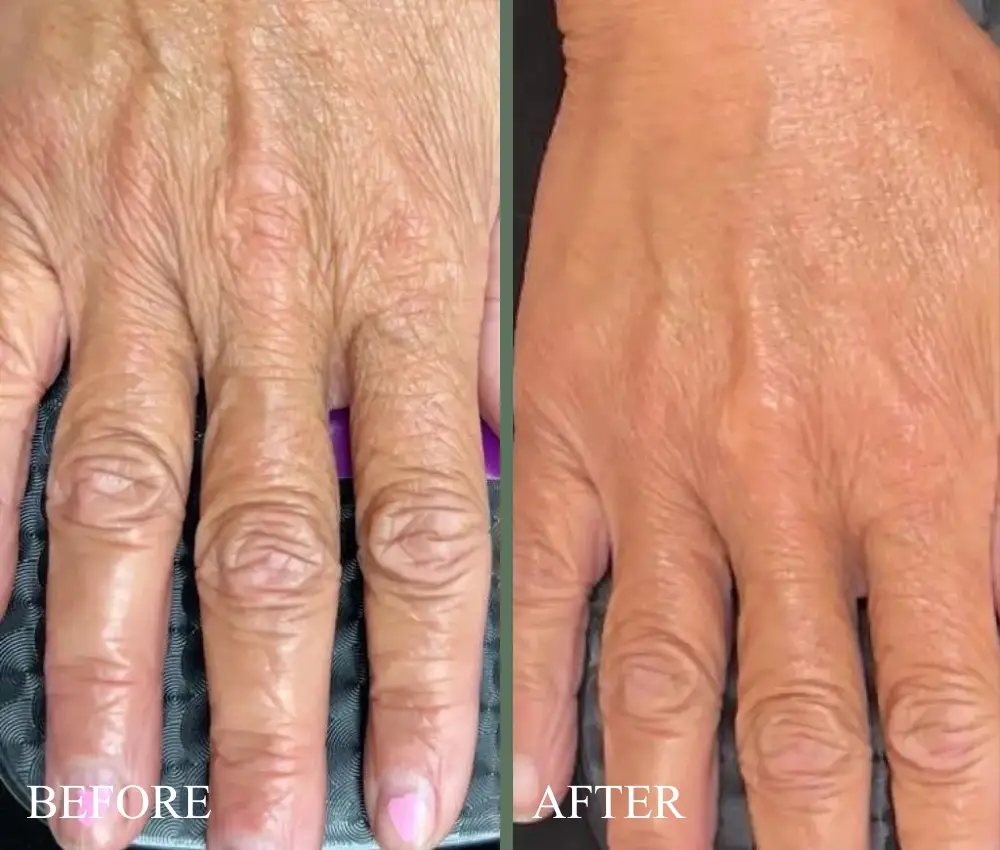 before after hands sylfirm x