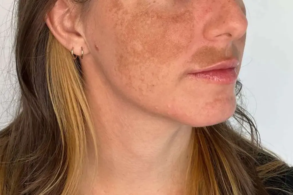 melasma