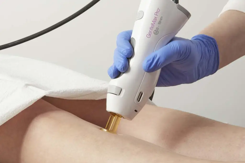 candela laser hair removal