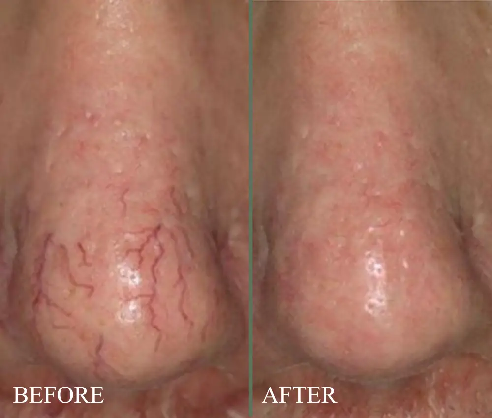 YAG 1064nm laser before aftervein
