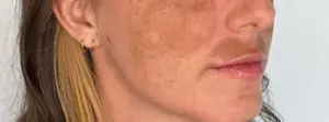 melasma