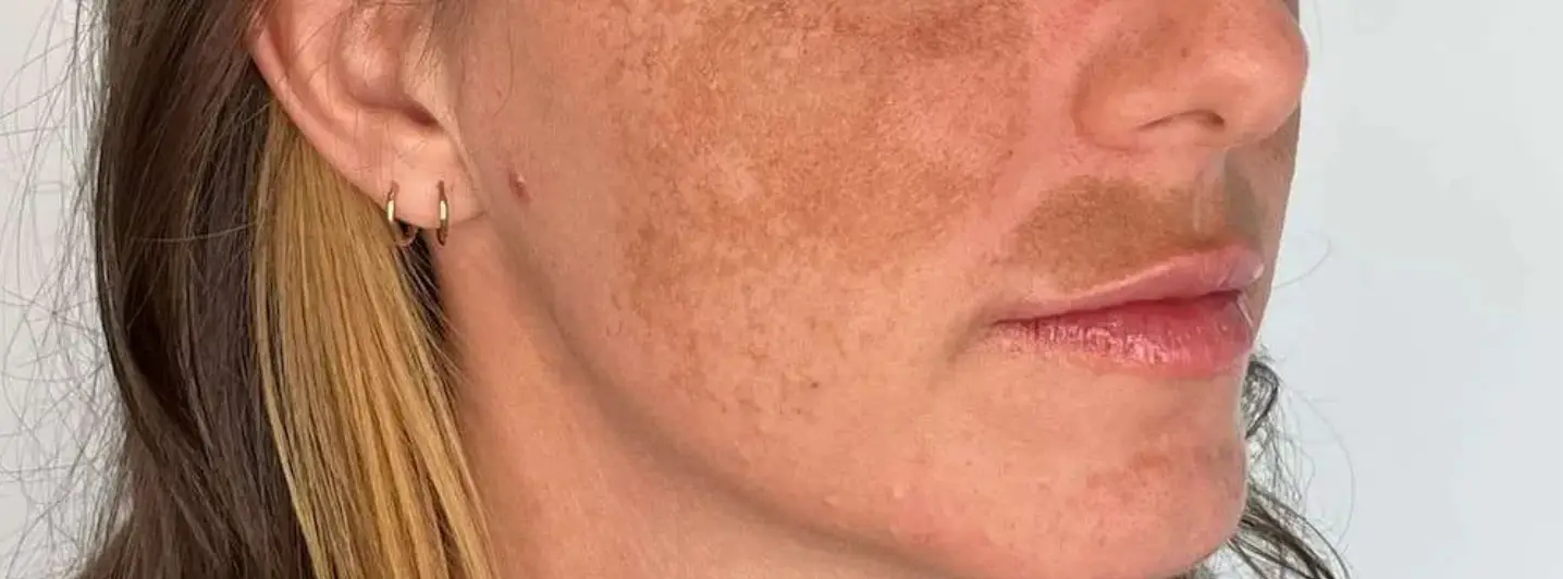 melasma