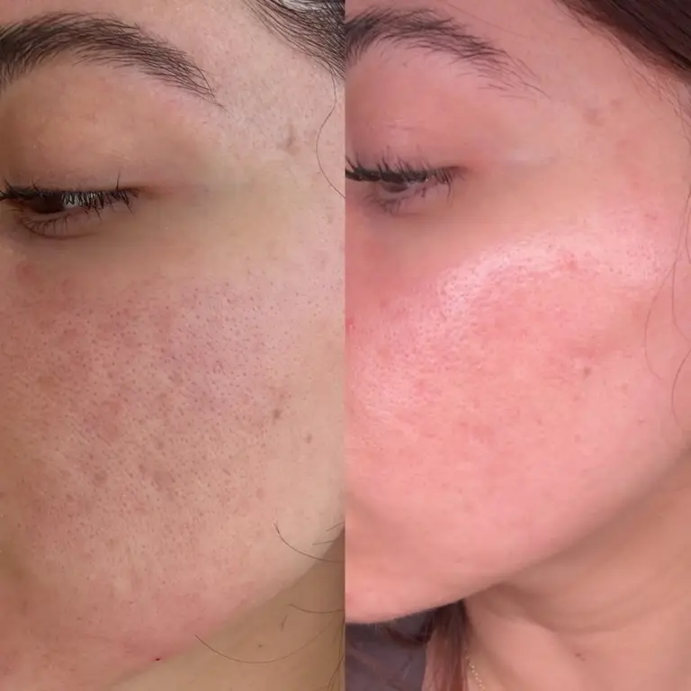 sylfirm rf microneedling
